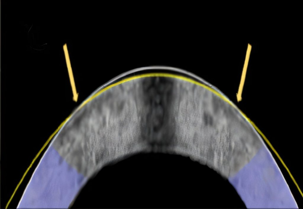 Близорукость предлагают лечить без лазера: корректировать зрение с помощью тока